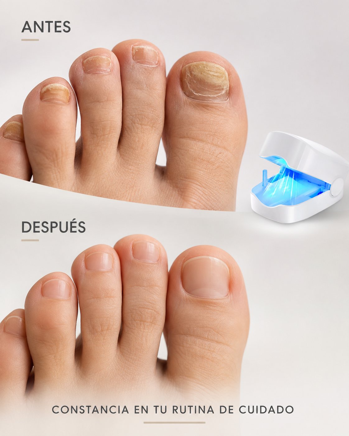 Antes y después del tratamiento láser para hongos en las uñas